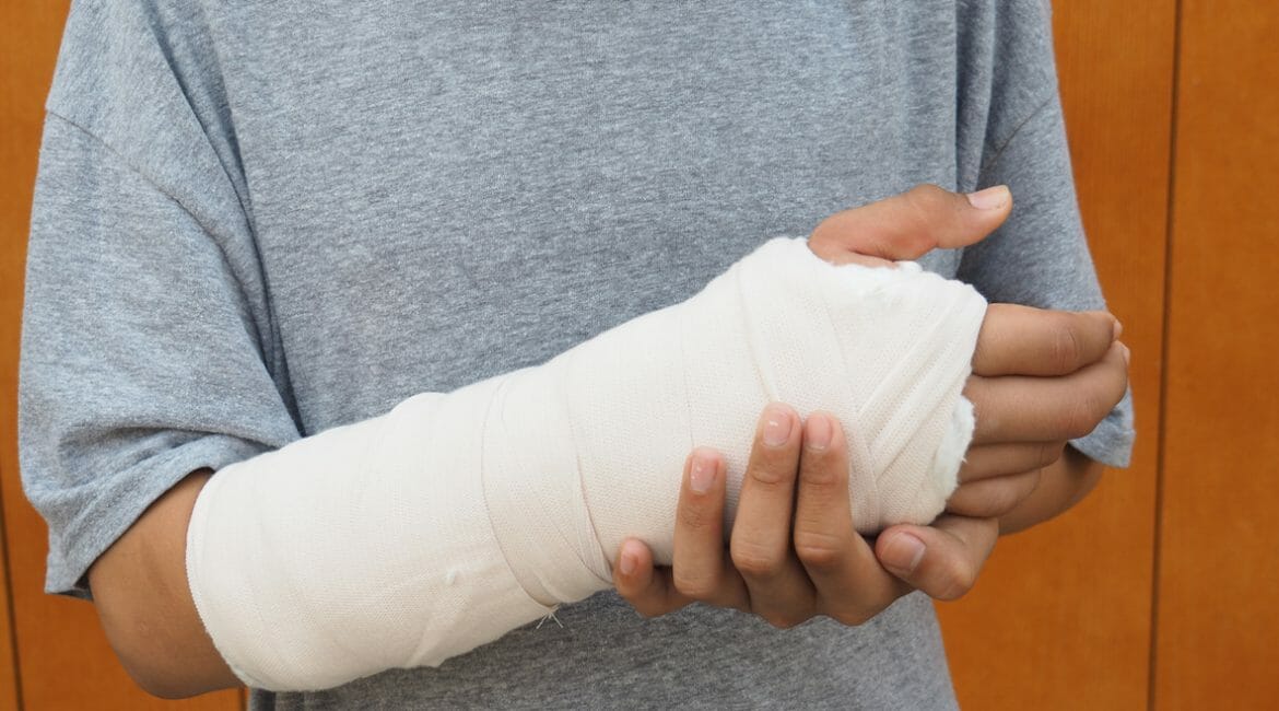 broken arm